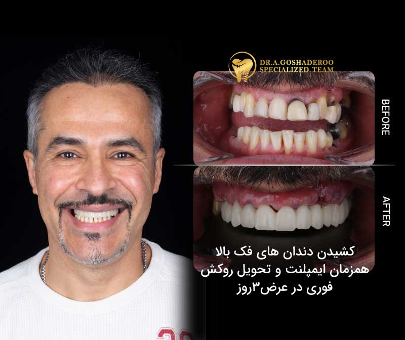 ایمپلنت